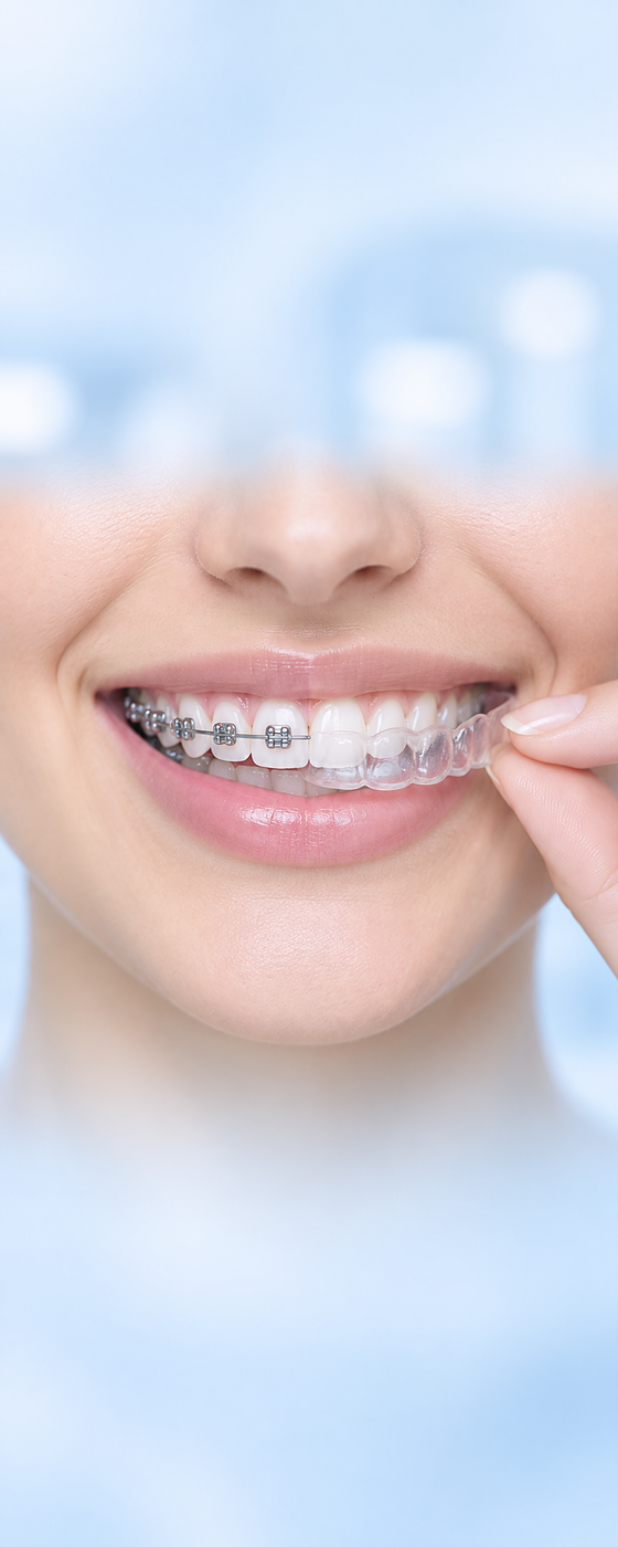 Modelli di denti con apparecchio tradizionale e allineatore trasparente affiancati